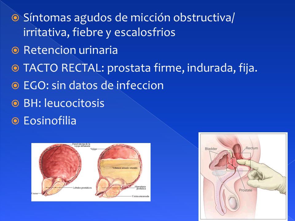 síntomas de fiebre de próstata